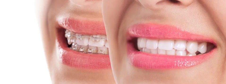 Invisalign® Dentist in Concord, CA